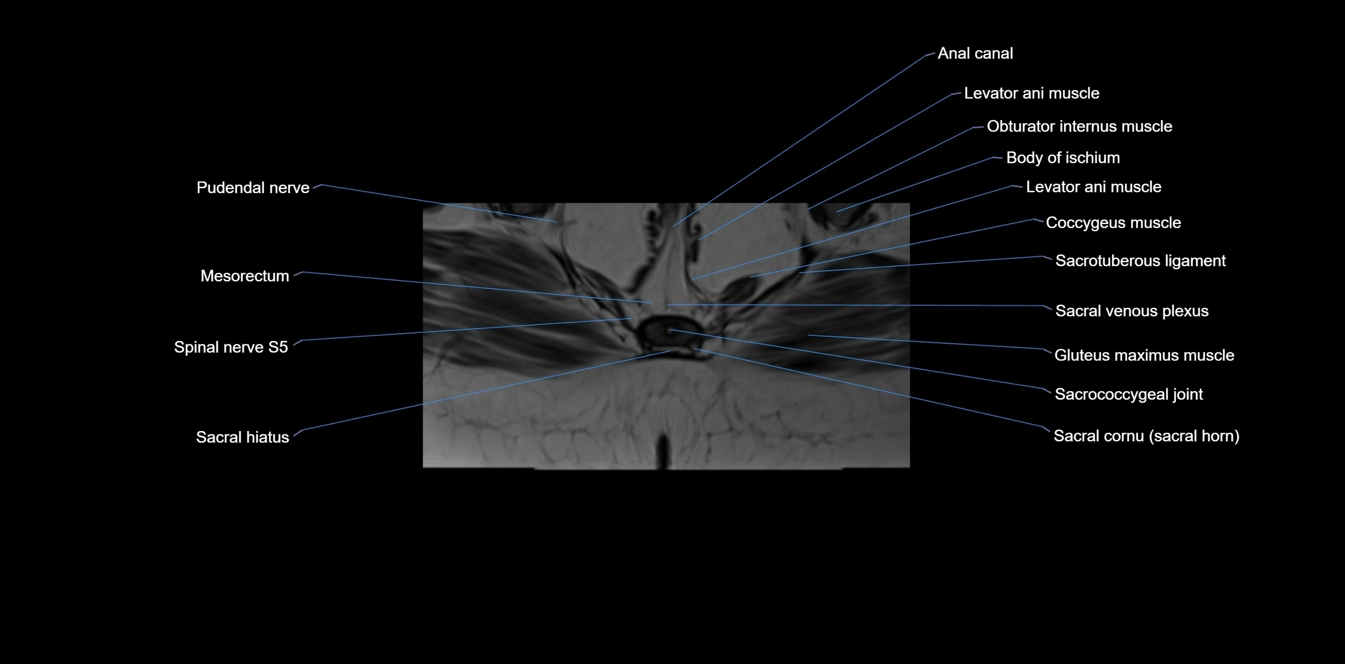 MRI sacrum, coccyx and sacroiliac joint axial cross sectional anatomy 3T  radiology  image-img-00001-00065.webp